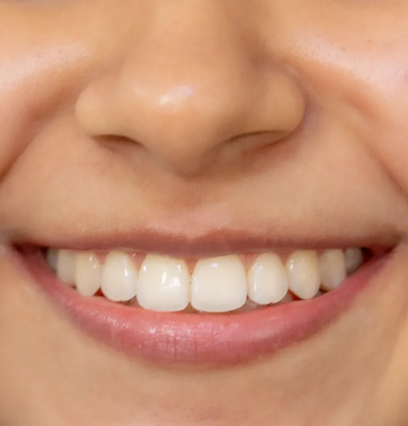 Sonrisa alineada